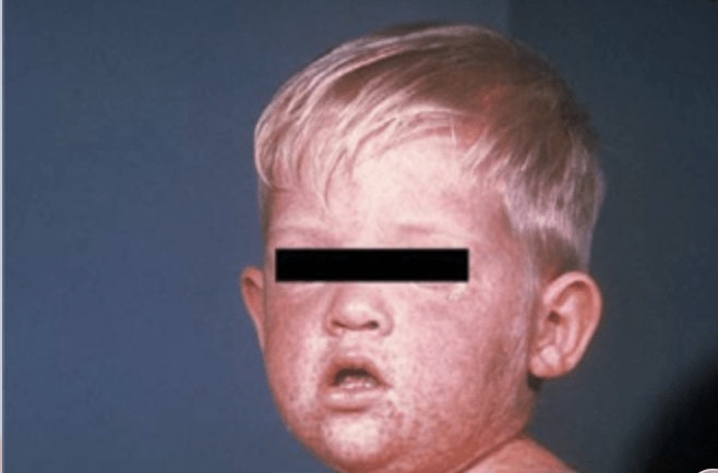 DPH confirms measles case in Georgia, working to identify others who may have had contact